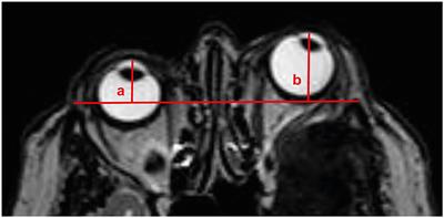 Outcome of Tumor-Associated Proptosis in Patients With Spheno-Orbital Meningioma: Single-Center Experience and Systematic Review of the Literature